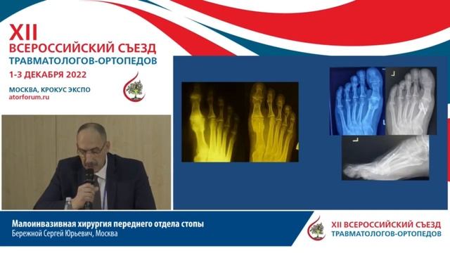 Малоинвазивная хирургия переднего отдела стопыБережной С.Ю. смотреть онлайн