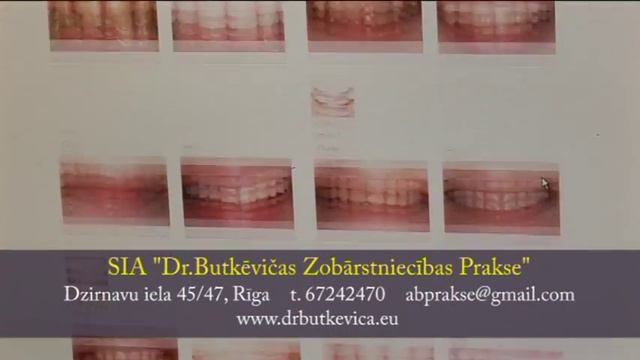 Dr.Butkēviča - zobu implantu nesāpīga ievietošana смотреть онлайн