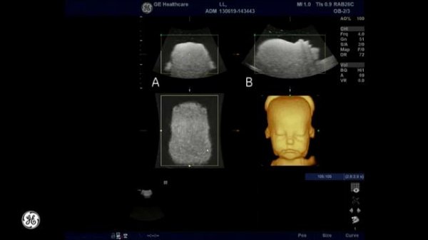 Обзор УЗИ аппарата General Electric Logiq F6