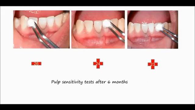 Endodontic Treatment Options in Questionable Teeth By Kenneth Pineda_2.mp4 смотреть онлайн