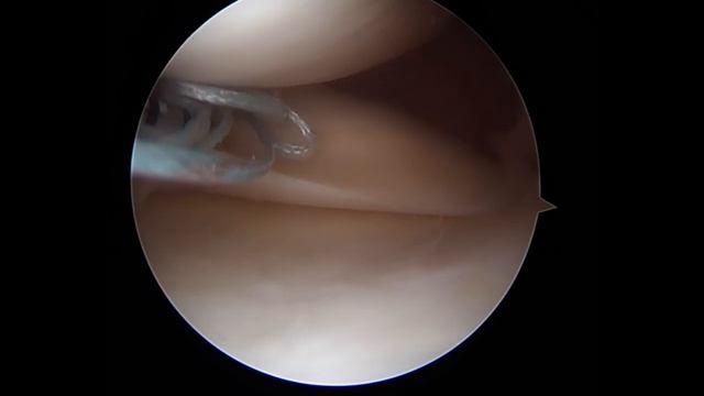 All Inside Medial Meniscal Repair - Arthroscopic Video смотреть онлайн