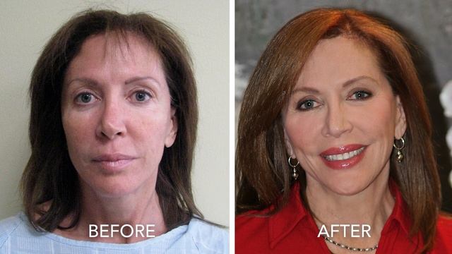 Why One Facelift Method is Very Effective while the Other is Quite Harmful [Dr Newman Explains] смотреть онлайн
