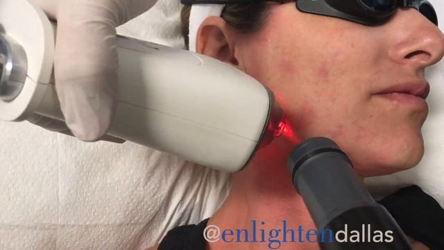Fraxel | Ditch Fine Lines and Wrinkles | Enlighten MD смотреть онлайн