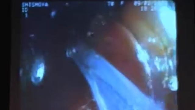 Первенство 07 Филатов М С Эндоскопическая коррекция билиодигестивного анастомоза через слепой коне смотреть онлайн