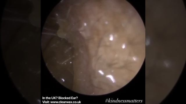 961 - Super Itchy Ear Wax Removal смотреть онлайн
