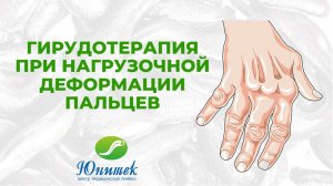 Гирудотерапия при нагрузочной деформации пальцев