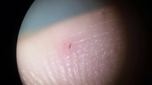 Как вытащить мелкую занозу у ребенка