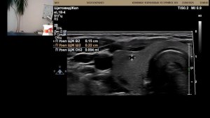 УЗИ щитовидной железы.  Есть узлы. Какие узлы не подлежат пункции?