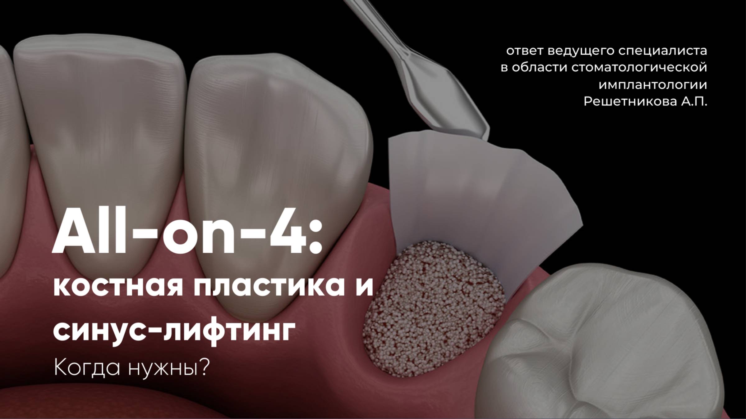 All-on-4: адаптация протокола под сложные случаи.