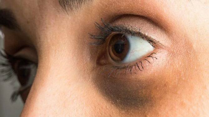 Как убрать темные круги под глазами смотреть онлайн