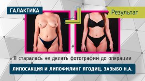 Минус бока, плюс талия: липоскульптура от Николая Александровича | До и после Шахризы