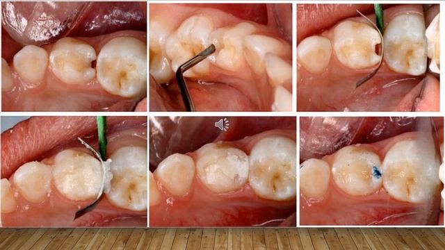 Atraumatic Restorative Technique - ART by Dr. Keyura Parakh смотреть онлайн