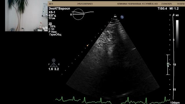 УЗИ сердца : Эхокардиография в  74  года через 20 лет после инфаркта.