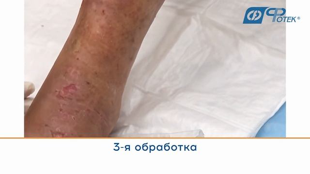 Метод ультразвуковой кавитации в лечении гнойной раны стопы смотреть онлайн