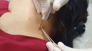 Лазерное удаление папилломы в медицинском центре "Чистая кожа", г. Дзержинск