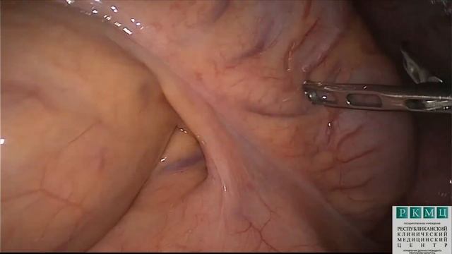 Экстрагенитальный эндометриоз: стенозирующий эндометриоз сигмовидной кишки смотреть онлайн