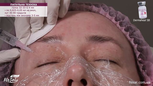 Корекція післяпологової гіперпігментації мезококтейлем 💉Dermaheal SB