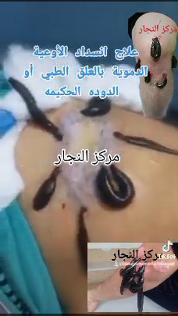 دودة العلق وعلاج انسداد الشرايين والاوعية الدموية