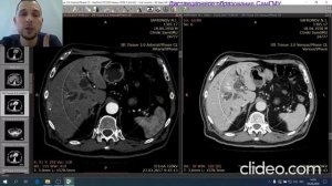 КТ органов брюшной полости. Разбор клинических случаев. Лектор Зельтер П.М.
