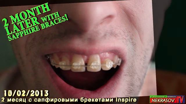 шоу NEKRASOV TV брекеты 1day with BRACES inspire / 2 month later with braces inspire! смотреть онлайн