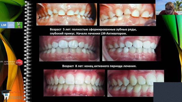Миофункциональный аппарат LM Activator