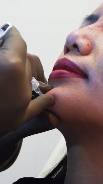 FILLERS TREATMENT || The Hair And Shape Clinic || Dr. Umang Kothari