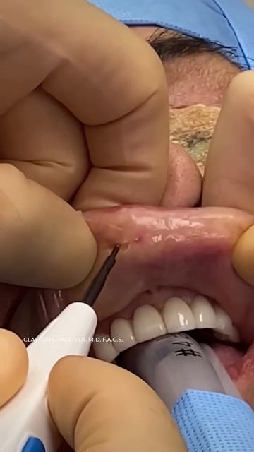 Silicone lip implant removal смотреть онлайн