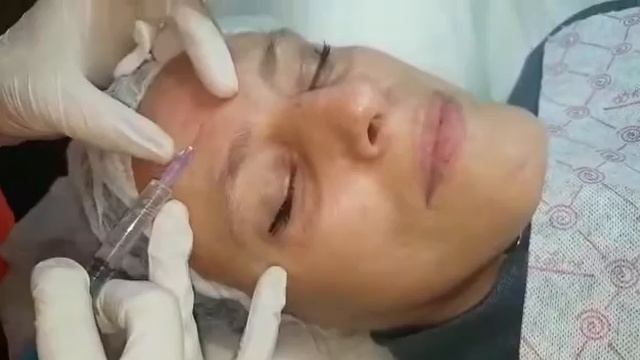 Процедура мезотерапии!!