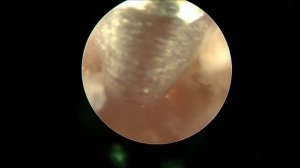 Цервикоскопия.Удаление полипа ц. канала после ГЭ.(шовный материал)