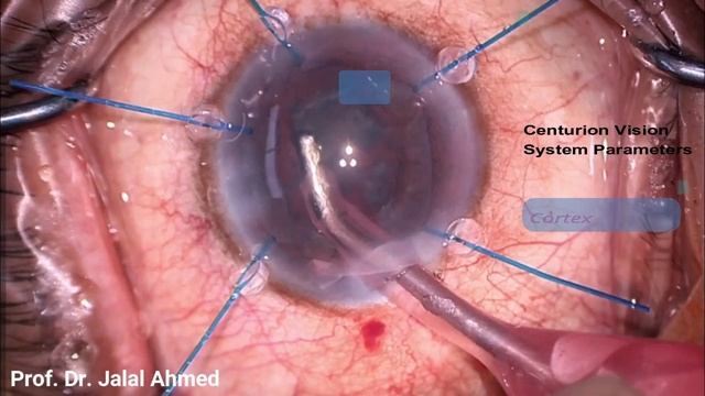 phacoemulsification/Episode:10/Prof. Jalal Ahmed/Iris Hooks, MP IOL, Optic Capture & PCR смотреть онлайн