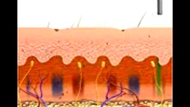 Laser nd: Q yang switched, eliminacion de tatuajes, www.laser-cleaner.co смотреть онлайн