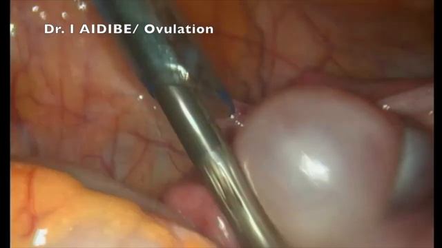 Ovulation - Laparoscopic View