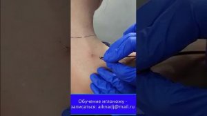 иглонож в шейной области