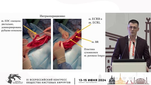 Ананкин А.А.: лечение застарелого минно-взрывного ранения предплечья при помощи транспозиции BR. смотреть онлайн