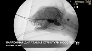 № 2-2020. Эндохирургия. Флюороскопия. Баллонная дилатация стриктуры носоглотки