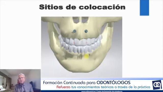 MICROTORNILLOS TERCERA PARTE