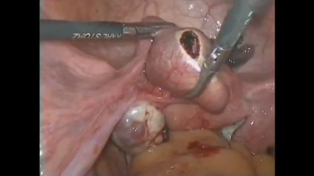 Позаматкова вагітність Органозберігаючі операції Сальпінгорафія Ectopic tube pregnancy смотреть онлайн