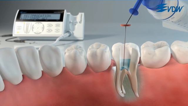 Sistema Reciproc® VDW - Simplicidade - Parte 03
