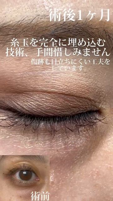 フォーエバー、糸玉、傷口、目立たないよう工夫。公開