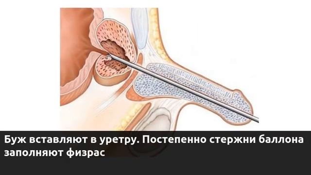Бужирование уретры