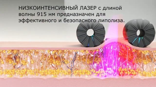 Технология icoone® LASER в Украине смотреть онлайн