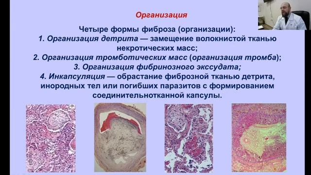 Лекция 5: Компенсаторно-приспособительные процессы. Иммунопатологические процессы. Амилоидоз. 05.11 смотреть онлайн