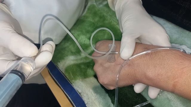 Intravenous injection through a butterfly catheter смотреть онлайн