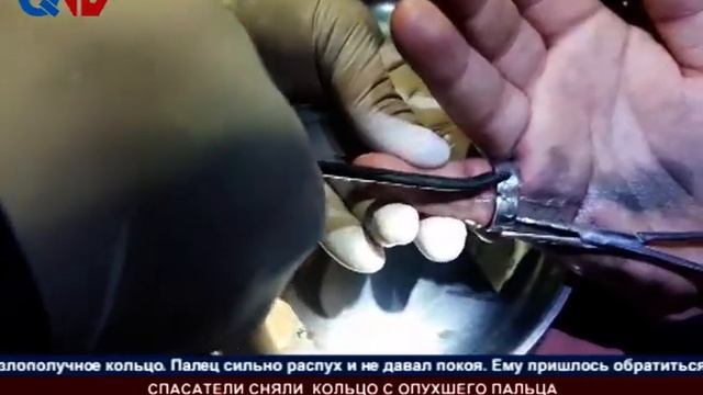 СПАСАТЕЛИ СНЯЛИ  КОЛЬЦО С ОПУХШЕГО ПАЛЬЦА