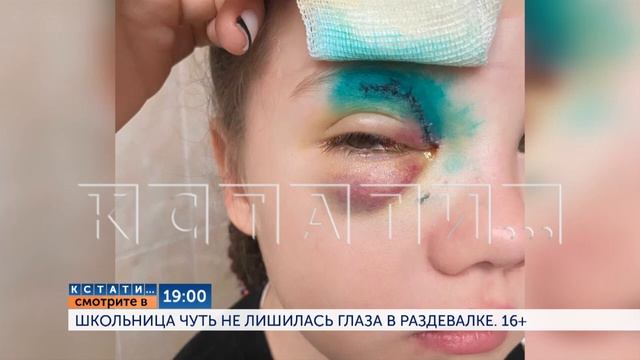 Смотрите сегодня в 19.00 в программе "Кстати": Школьница чуть не лишилась глаза в раздевалке смотреть онлайн