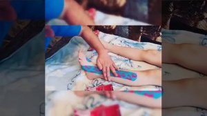 Тейпирование при косолапии