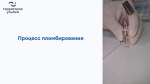 Пломбирование канала латеральной конденсацией