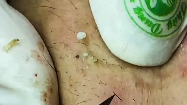 Episode 15 \ Lots of black dots! Squeezing black dots смотреть онлайн