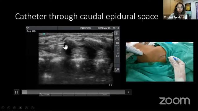 PRAC WEBINAR SERIES 12 : CAUDAL EPIDURAL BLOCK смотреть онлайн