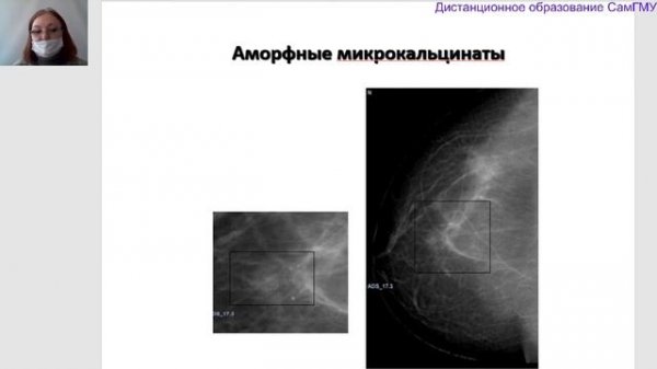 BI RADS Лектор Колосова И Н